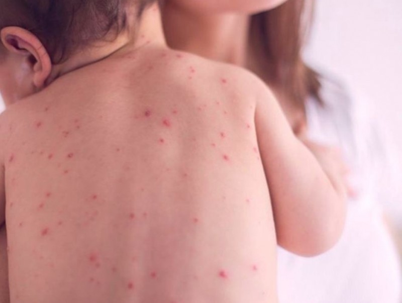 Хүүхдээ улаанбурхан өвчний дархлаажуулалтад хамрагдсан эсэхийг шалгах боломжтой